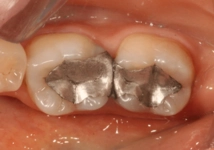 Diş Dolgusu Gusle Mani midir?